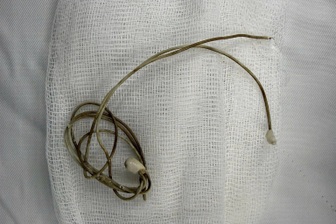 Gắp dây sạc trong bàng quang nam sinh 16 tuổi