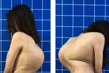 Giải cứu cô gái mang "mai rùa" trên lưng