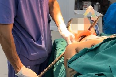 Thanh xà beng dài 90cm đâm xuyên cổ người bệnh
