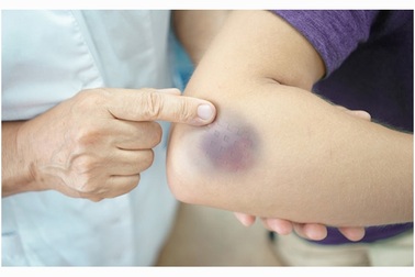 Thảo dược trị chấn thương và vết thương phần mềm