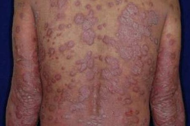 Cafein giúp phòng bệnh vẩy nến?