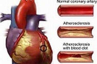 Xơ vữa động mạch - kẻ giết người thầm lặng