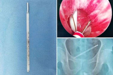 Đưa nhiệt kế vào "của quý" tìm cảm giác lạ, bị chui tọt vào trong, không tài nào lấy ra được