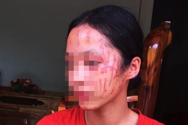 Nữ sinh lớp 8 bị "đàn chị" cào nát mặt