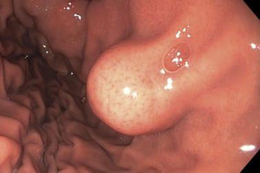 Đau bụng, khó đi ngoài coi chừng bệnh ung thư hiếm gặp