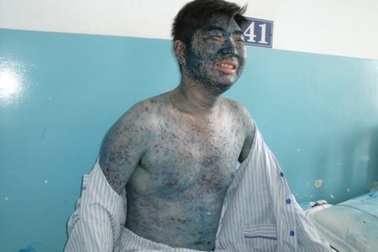 Bệnh thủy đậu “tấn công” người lớn