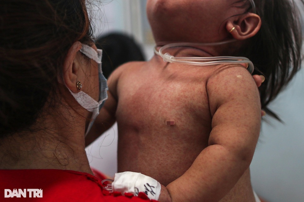 Toàn cảnh chiến dịch tiêm 1.134.200 liều vaccine chặn sởi - 2 Toàn cảnh chiến dịch tiêm 1.134.200 liều vaccine chặn sởi - 2