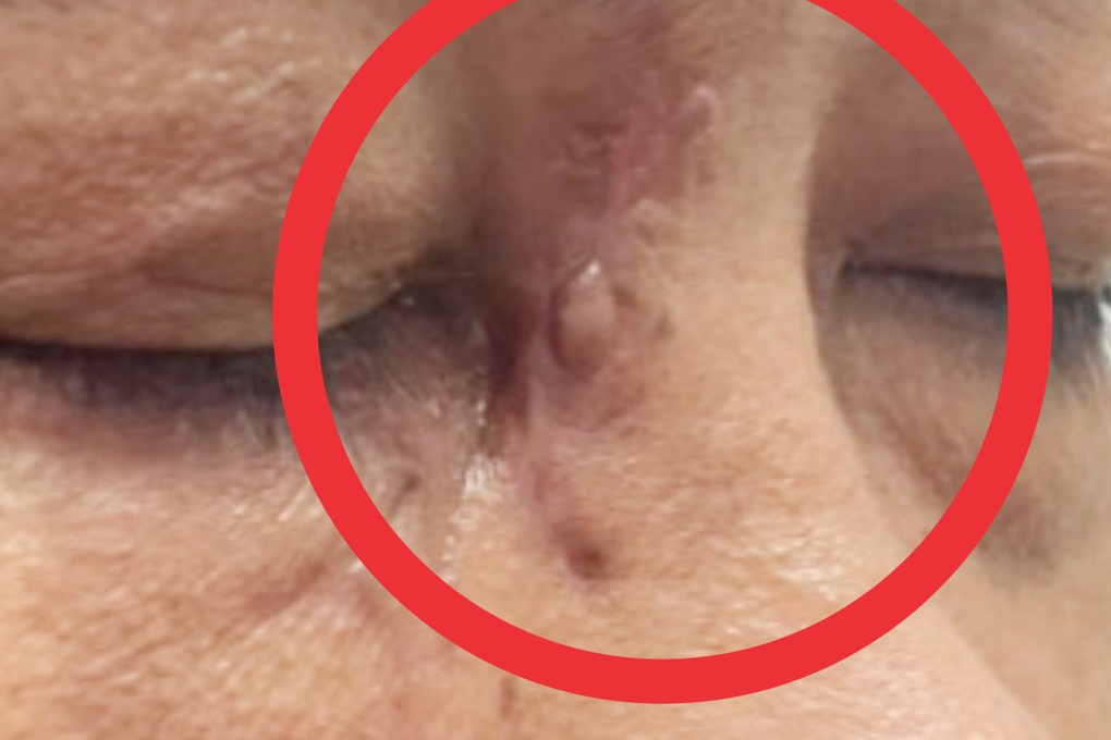 Nhiều mảnh kính vỡ nằm sâu trong mũi người đàn ông - 1 Nhiều mảnh kính vỡ nằm sâu trong mũi người đàn ông - 1