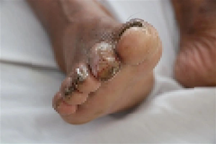 Bệnh nhi bị "vi khuẩn ăn thịt" tấn công