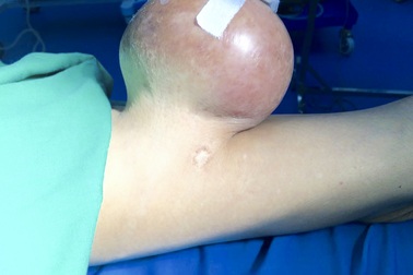 Giải phóng khối u nặng 2kg bốc mùi đeo bám người đàn ông suốt 12 năm