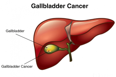 Các triệu chứng của u ác tính túi mật