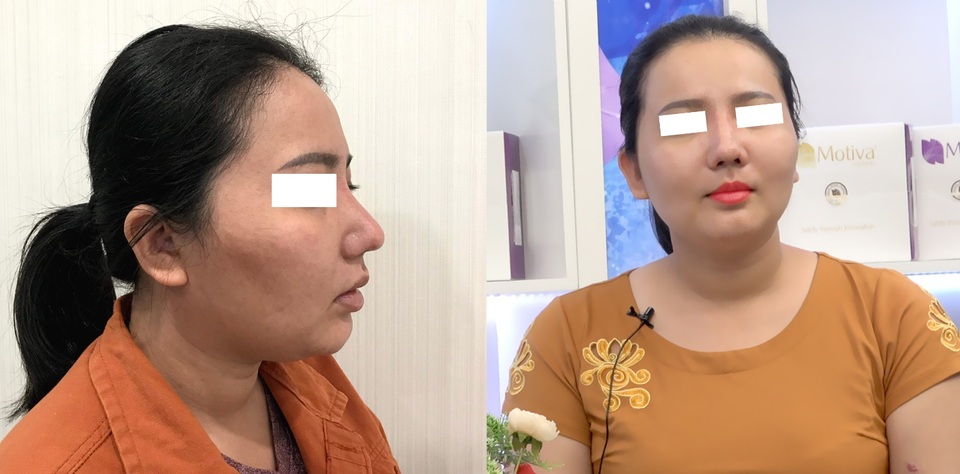 Số phận của những ca phẫu thuật thẩm mỹ mũi hỏng sẽ đi về đâu? - 3 Số phận của những ca phẫu thuật thẩm mỹ mũi hỏng sẽ đi về đâu? - 3
