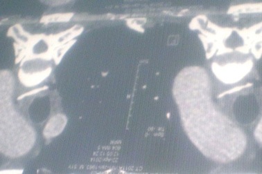 Xương gà xuyên thủng thực quản, bệnh nhân suýt tử vong