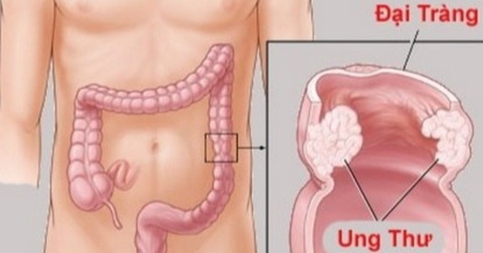 Có thể ngăn ngừa ung thư đại trực tràng không? - 1 Có thể ngăn ngừa ung thư đại trực tràng không? - 1