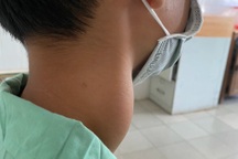 Quảng Nam: Phẫu thuật khối u lớn hiếm gặp ở vùng cổ bệnh nhân 13 tuổi
