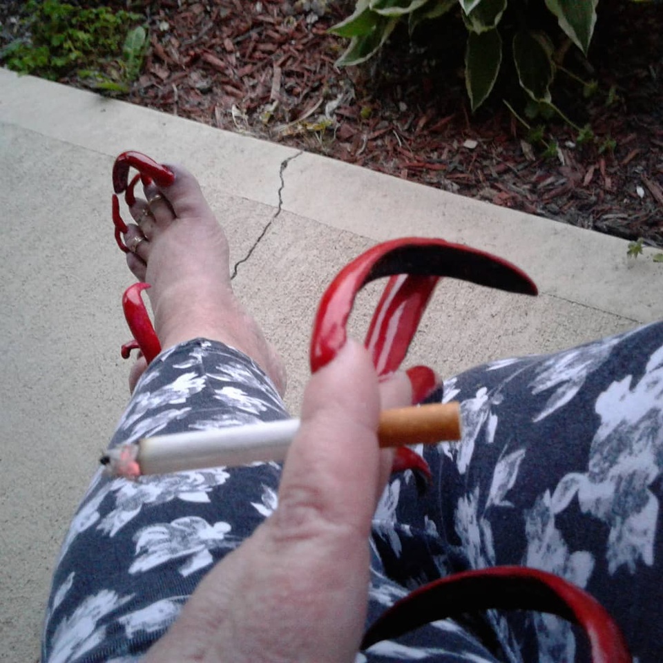 Người phụ nữ không thể đi giày vì móng chân quá dài - 2 Người phụ nữ không thể đi giày vì móng chân quá dài - 2