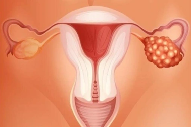 6 yếu tố liên quan đến ung thư buồng trứng