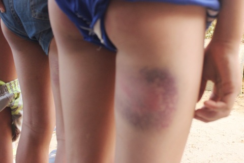 6 nam sinh cấp hai bị thầy giáo chủ nhiệm đánh bầm đùi