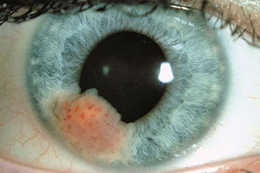 Các yếu tố nguy cơ gây ung thư mắt