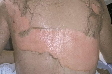 Tự ý dùng thuốc coi chừng hội chứng Lyell chết người