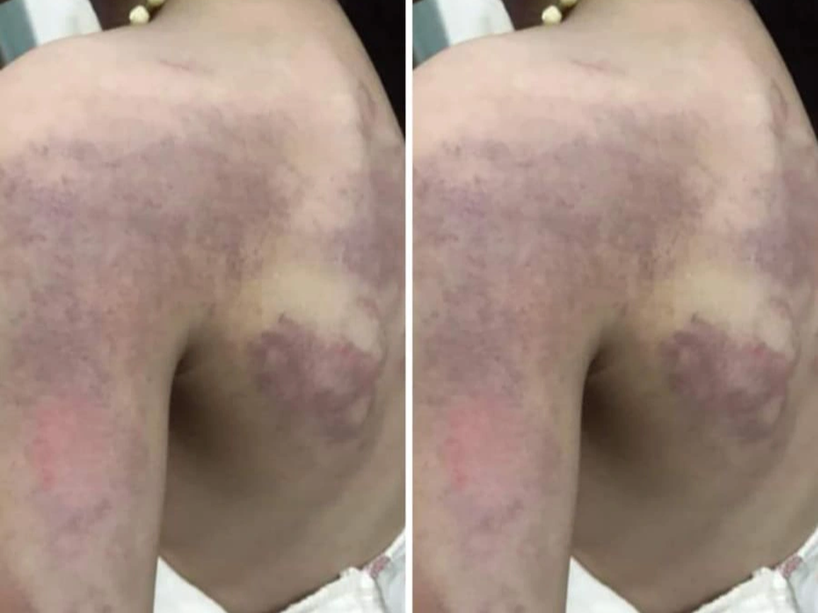 Học sinh lớp 3 nghi bị cô giáo đánh bầm tím người vì không làm được bài - 1 Học sinh lớp 3 nghi bị cô giáo đánh bầm tím người vì không làm được bài - 1