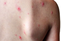 Chuyên gia cảnh báo khi Việt Nam xuất hiện ca bệnh đậu mùa khỉ