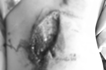 Đang chơi ngoài sân, bé gái bị mảnh mái tôn rơi xuống vỡ toác lưng