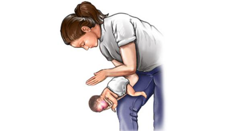 Minh họa thao tác vỗ lưng, ấn ngực khi trẻ dưới 2 tuổi bị hóc dị vật (Ảnh minh họa: Vinmec). Minh họa thao tác vỗ lưng, ấn ngực khi trẻ dưới 2 tuổi bị hóc dị vật (Ảnh minh họa: Vinmec).