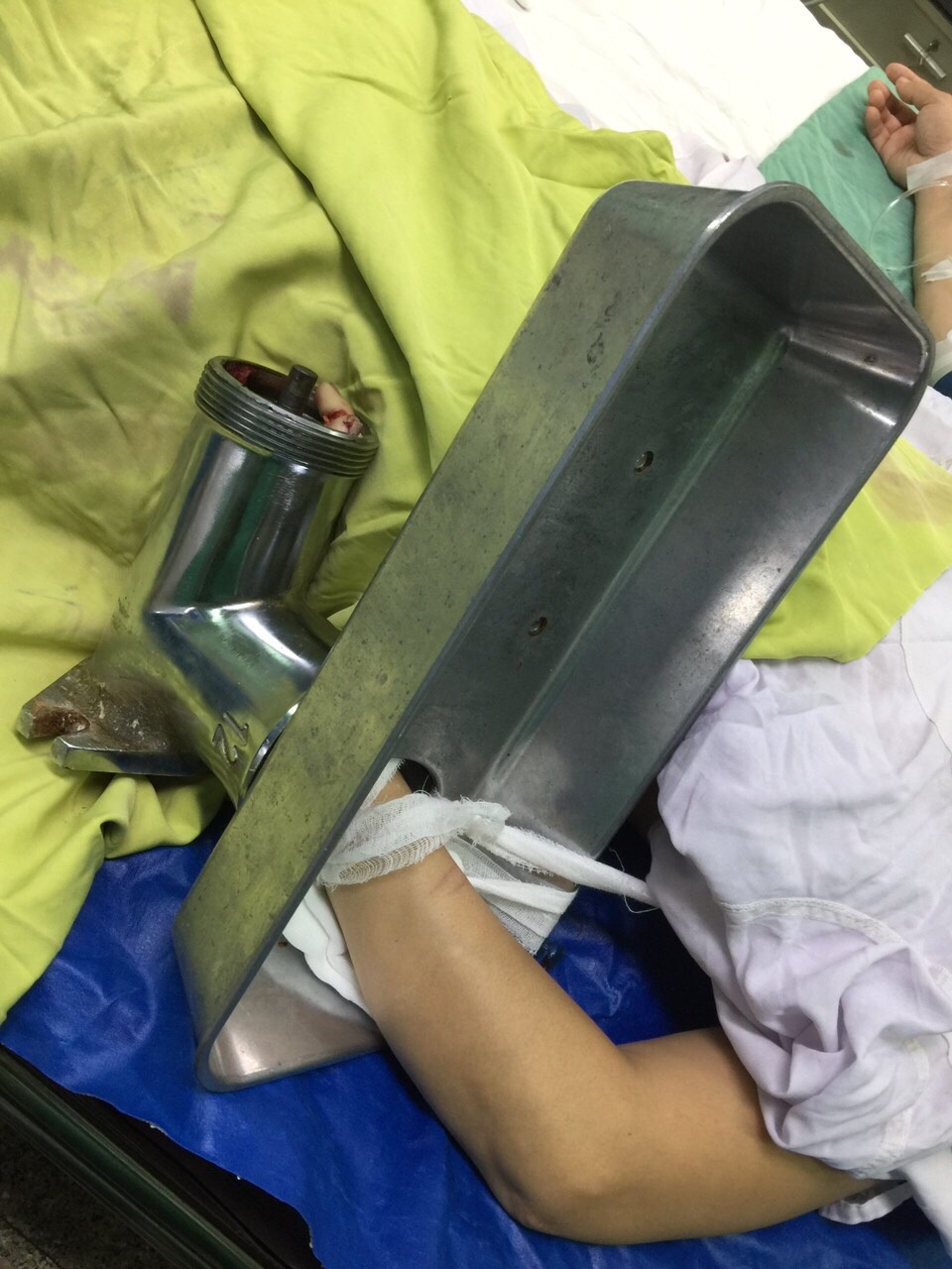 Mang bàn tay dập nát kẹt trong máy xay thịt đến bệnh viện - 1 Mang bàn tay dập nát kẹt trong máy xay thịt đến bệnh viện - 1