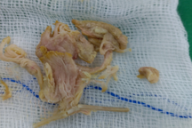 Cụ ông U80 hóc xương gà nguy kịch được cứu sống ở Cần Thơ