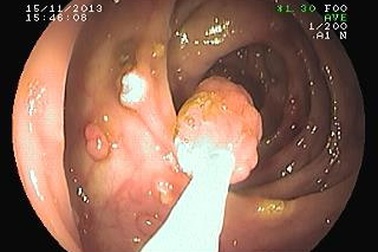 Nội soi cắt gần 40 u lành ở ruột già