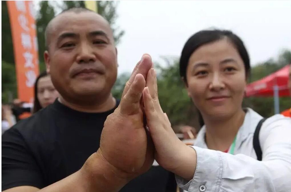 Bàn tay dày bất thường của võ sư mê truyện Kim Dung luyện võ hơn 20 năm - 1 Bàn tay dày bất thường của võ sư mê truyện Kim Dung luyện võ hơn 20 năm - 1
