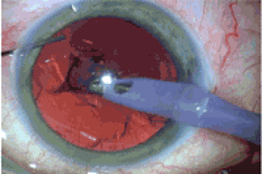 Phục hồi thị lực tối đa nhờ phương pháp Phaco