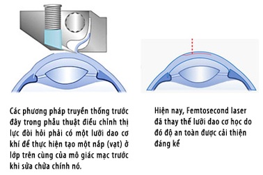 Femtosecond Laser: Chọn lựa mới để phục hồi thị lực