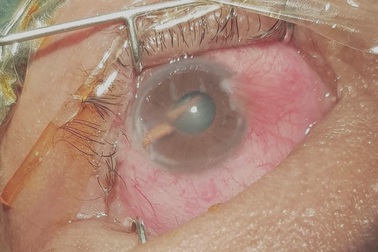 Chấn thương nặng vì dụi mắt sau khi bị gai mây đâm xuyên nhãn cầu