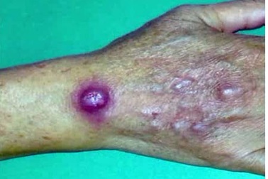 Mỹ: Nhiễm trùng da hiếm gặp từ chợ cá khu người Hoa 