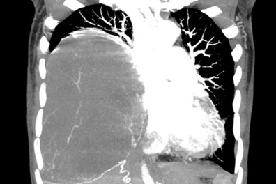 Khối u nặng 2kg choán hết lồng ngực bệnh nhân