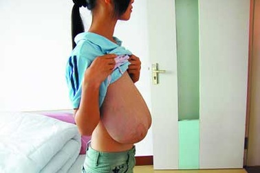 Thiếu nữ có bộ ngực “quá khổ”