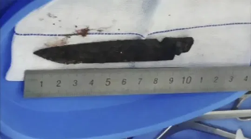 Lưỡi dao dài 10cm nằm trong đầu suốt 26 năm - 4 Lưỡi dao dài 10cm nằm trong đầu suốt 26 năm - 4