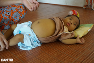 Người mẹ nghèo khẩn cầu cứu con gái 8 tháng tuổi bị teo mật bẩm sinh