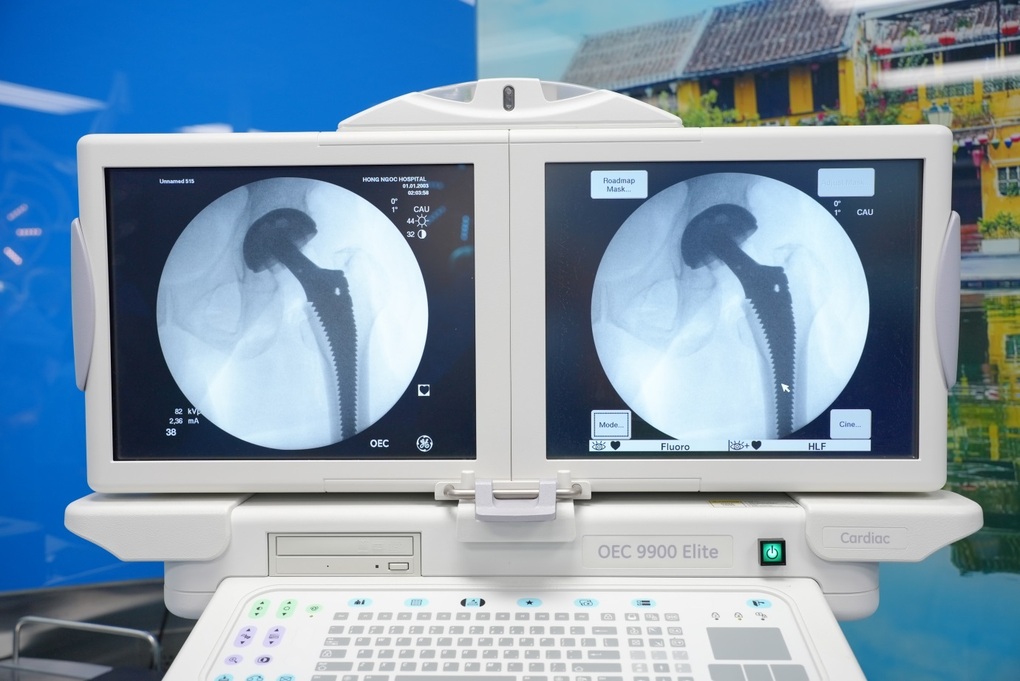 Thay khớp háng DAA - chấm dứt 10 năm chân thấp chân cao, đi xe máy dễ dàng - 2 Thay khớp háng DAA - chấm dứt 10 năm chân thấp chân cao, đi xe máy dễ dàng - 2