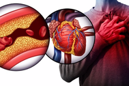Dấu hiệu cảnh báo nhồi máu cơ tim ai cũng cần biết