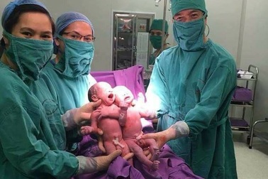 Hy hữu 2 bé sinh đôi cùng trứng chào đời từ phương pháp thụ tinh ống nghiệm