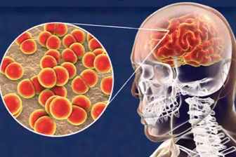 Gia tăng ca bệnh não mô cầu, thể tối cấp có thể tử vong trong 24 giờ