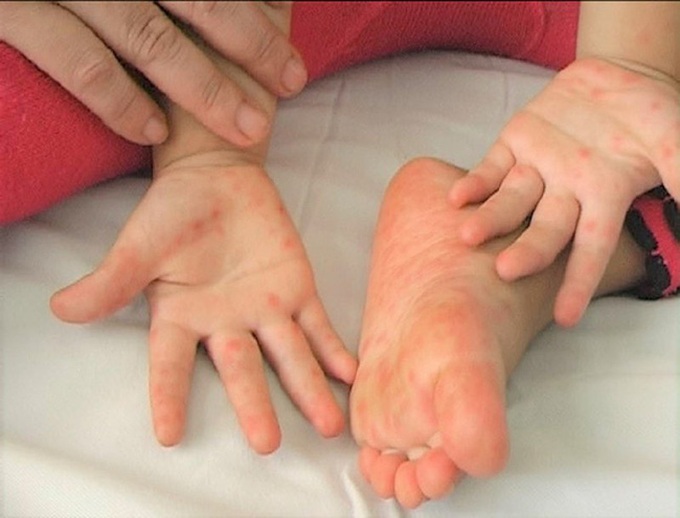 Dịch tay chân miệng bùng phát phức tạp, cả nước có 4 ca tử vong - Ảnh 2. Dịch tay chân miệng bùng phát phức tạp, cả nước có 4 ca tử vong - Ảnh 2.