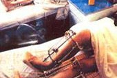 Kéo dài chân kiểu mới 