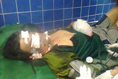 Bị thương nặng do cuốc trúng bom