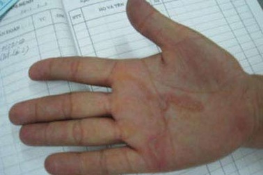 Hải Phòng: Xuất hiện bệnh giun bò dưới da 