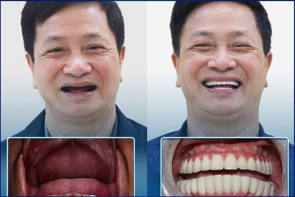 Công nghệ Safe Tech: Trồng răng an toàn và thành công cho người cao tuổi - 3 Công nghệ Safe Tech: Trồng răng an toàn và thành công cho người cao tuổi - 3