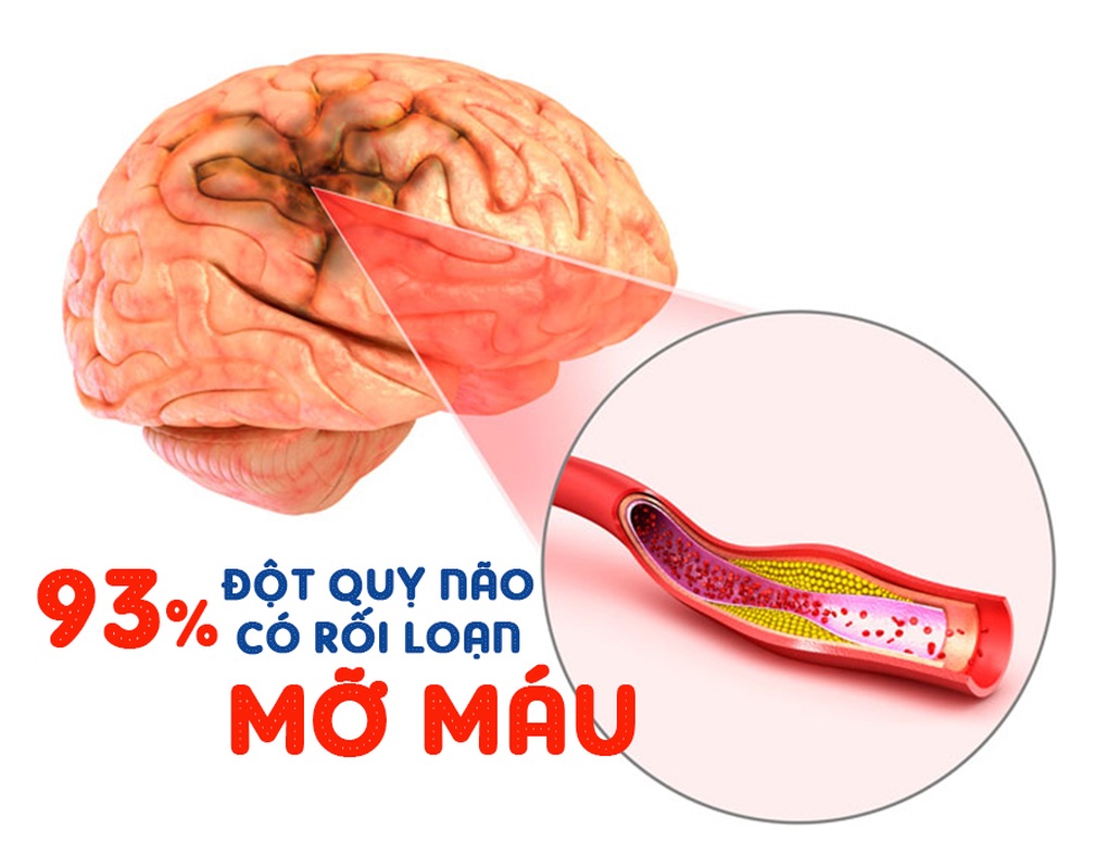 Nguy cơ đột quỵ do mỡ máu tăng cao sau Tết - 1 Nguy cơ đột quỵ do mỡ máu tăng cao sau Tết - 1